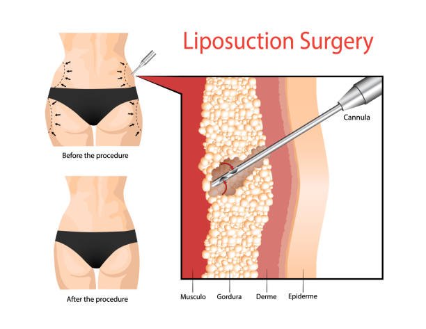 Cara Kurus Dengan Cepat & Selamat Untuk Turunkan Berat Badan (2025) 3 cara-kurus-dengan-cepat-liposuction-surgery