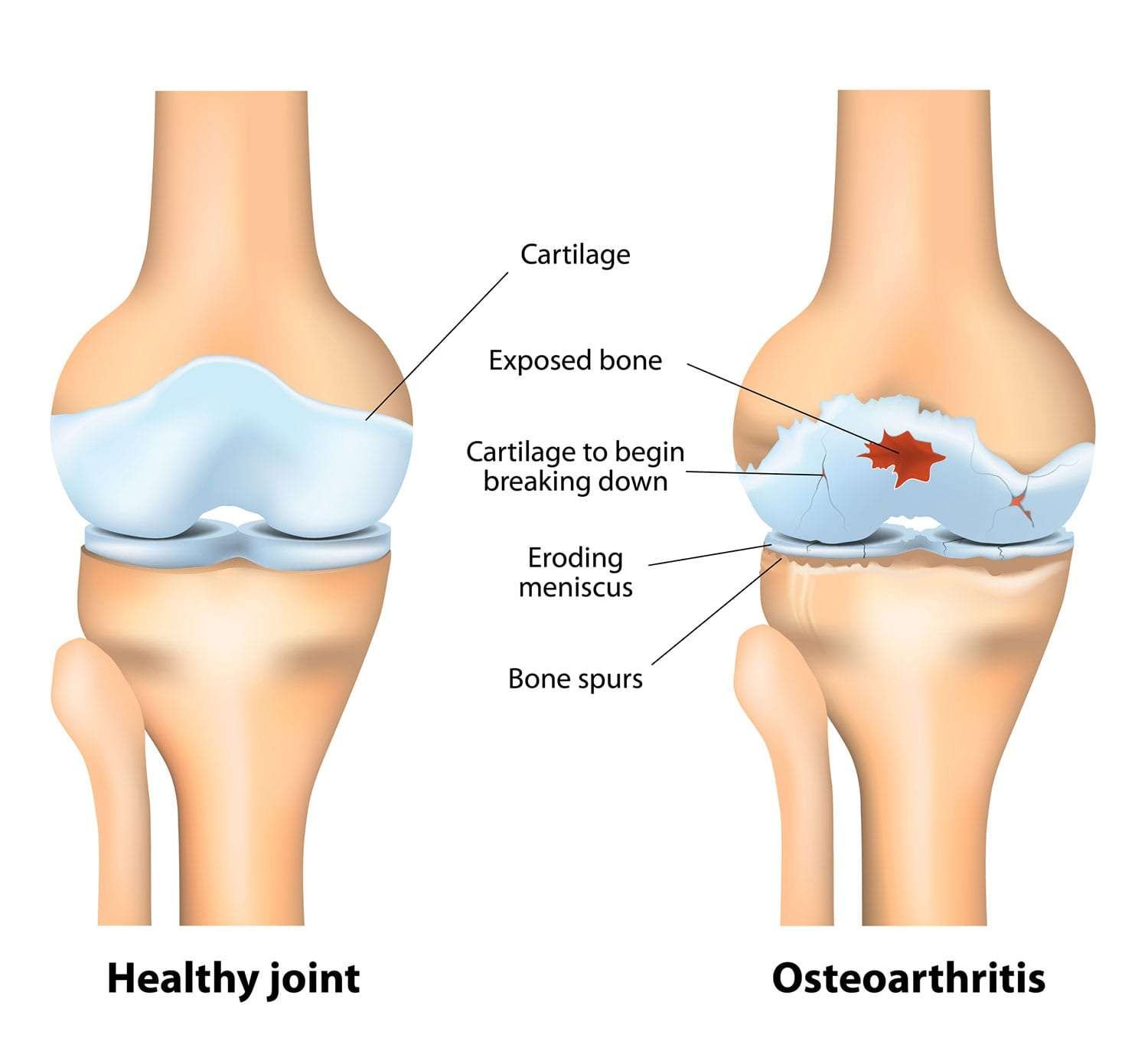 Sakit Sendi: Punca, Tanda, Rawatan & Makanan Yang Perlu Dielakkan 2 Osteoarthritis-sakit-sendi