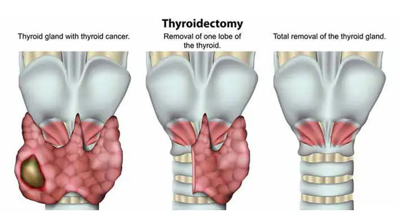 Thyroid Malaysia: Function, Disorders, Symptoms, Surgery & Treatment 4 thyroid-surgery-malaysia