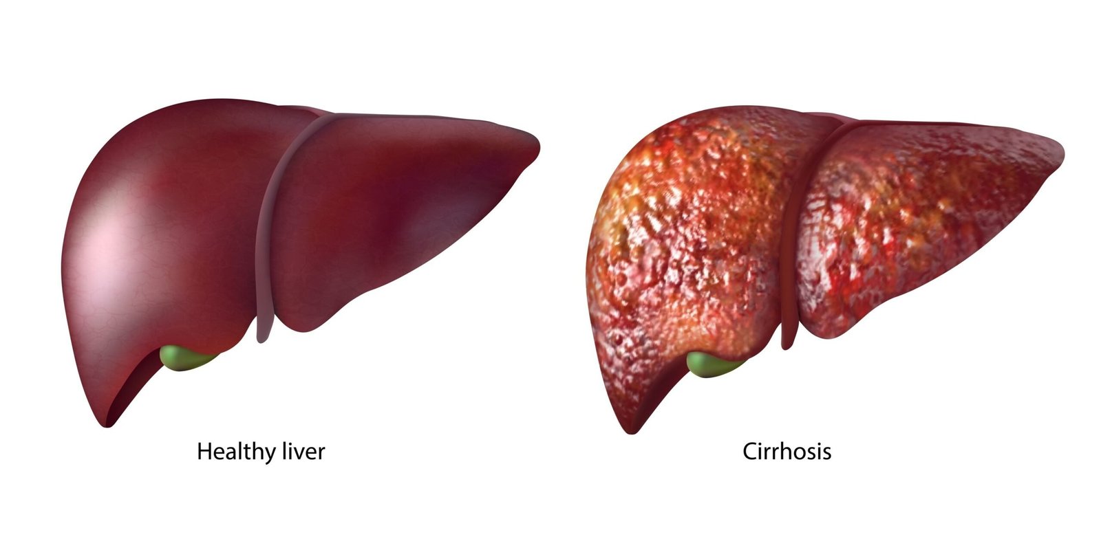 Sirosis Hati: Simptom, Punca & Rawatan di Malaysia 2 Sirosis Hati Cirrhosis liver