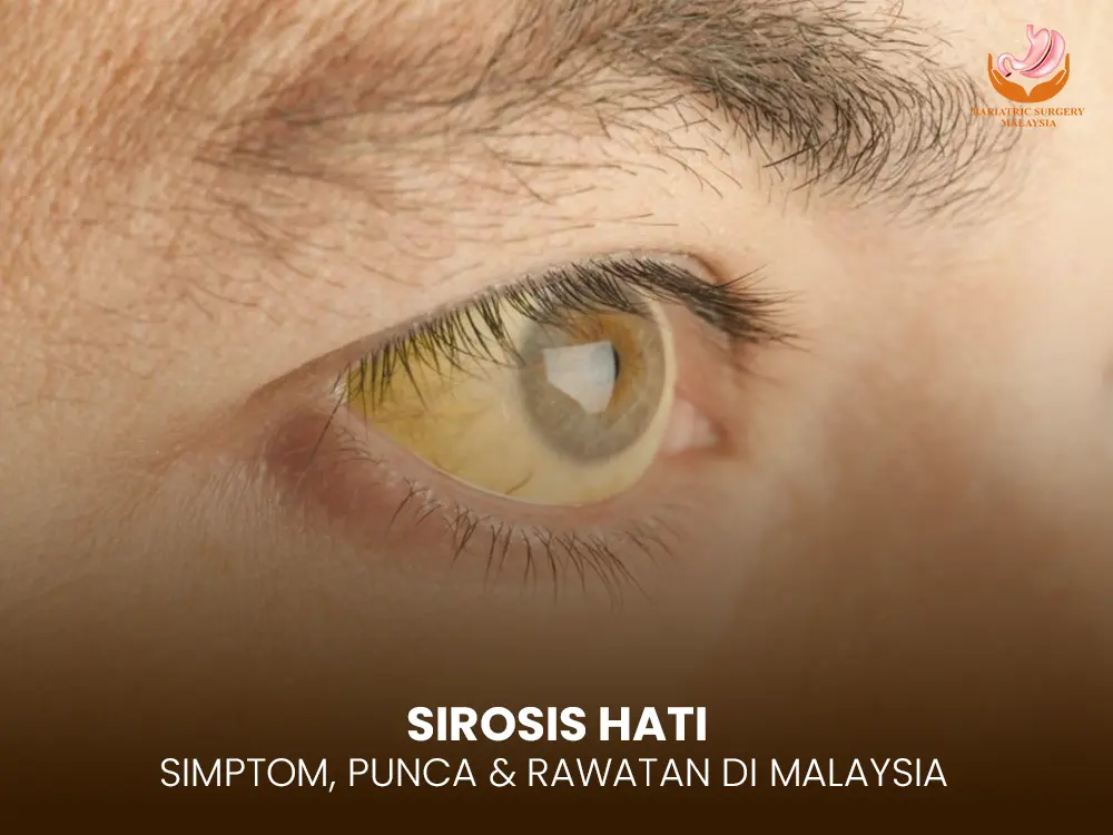 sirosis-hati