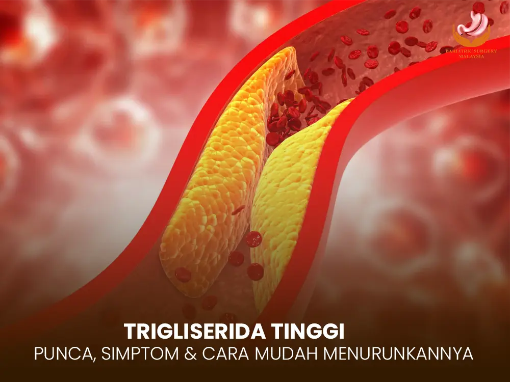 Trigliserida Tinggi