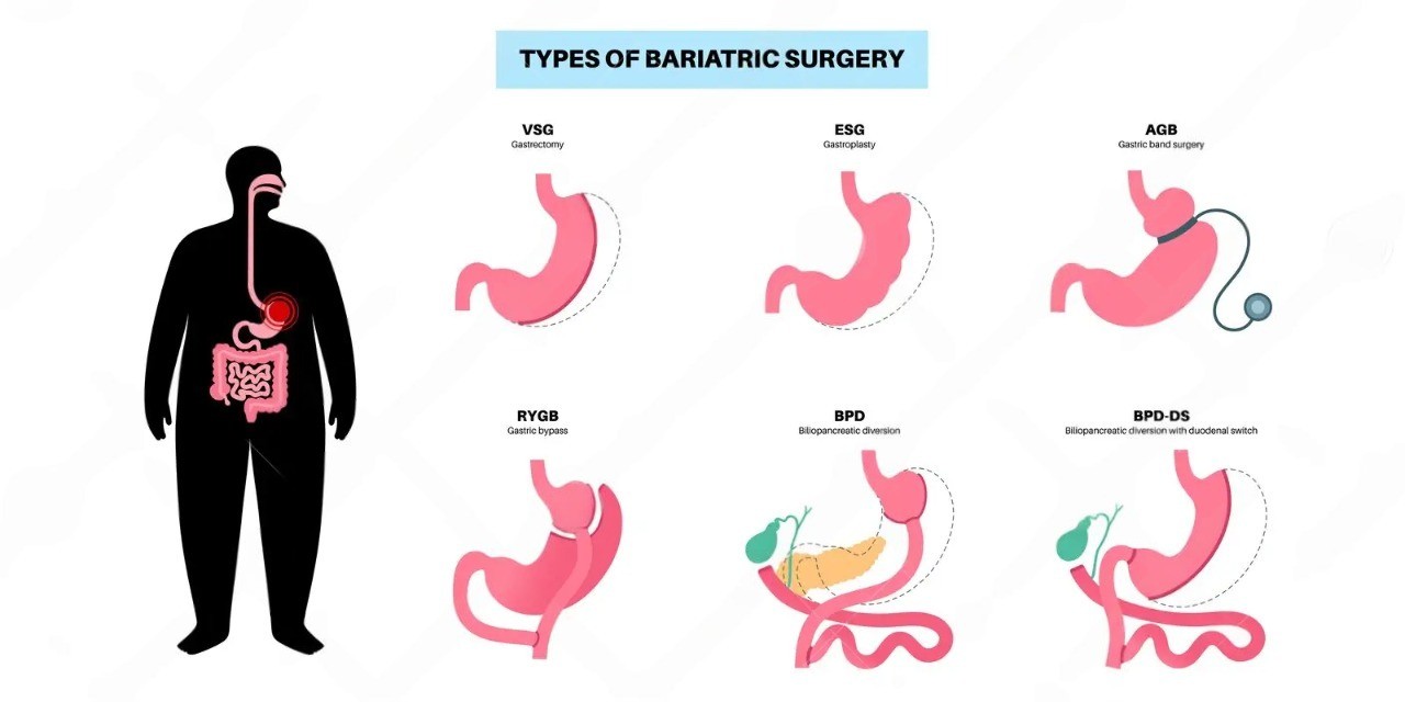 How Much Does Bariatric Surgery Cost in Malaysia? A Complete Pricing Guide 1 Bariatric Surgery Cost in Malaysia: What to Expect