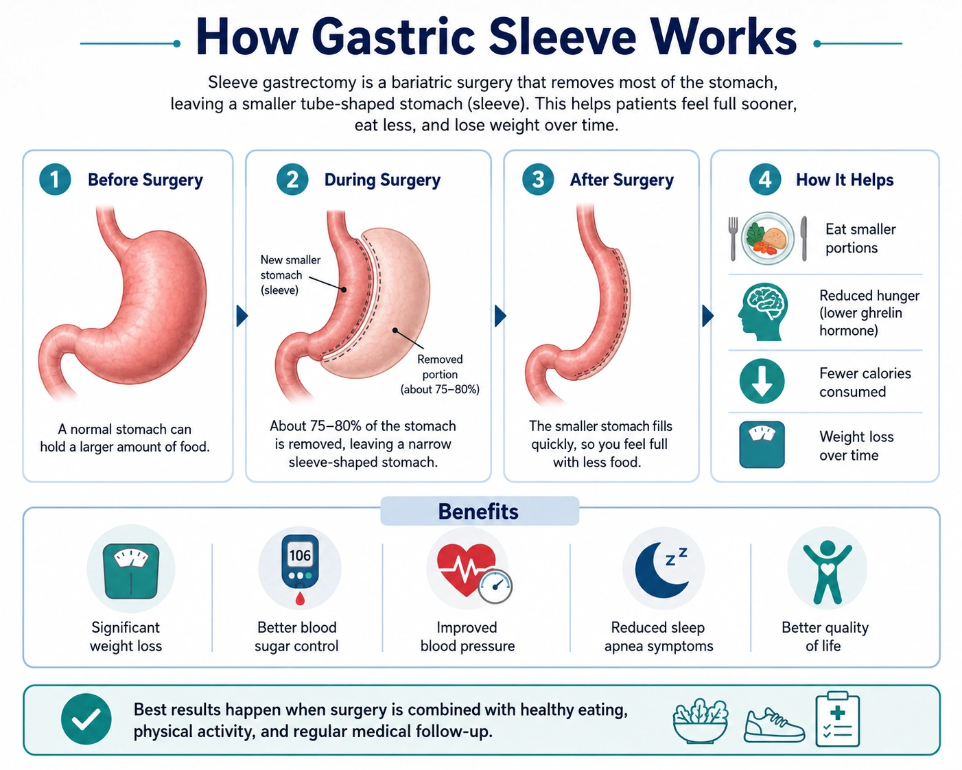 Gastric Sleeves in Malaysia: Cost, Results, and Risks 1 How Gastric Sleeves Work for Weight Loss
