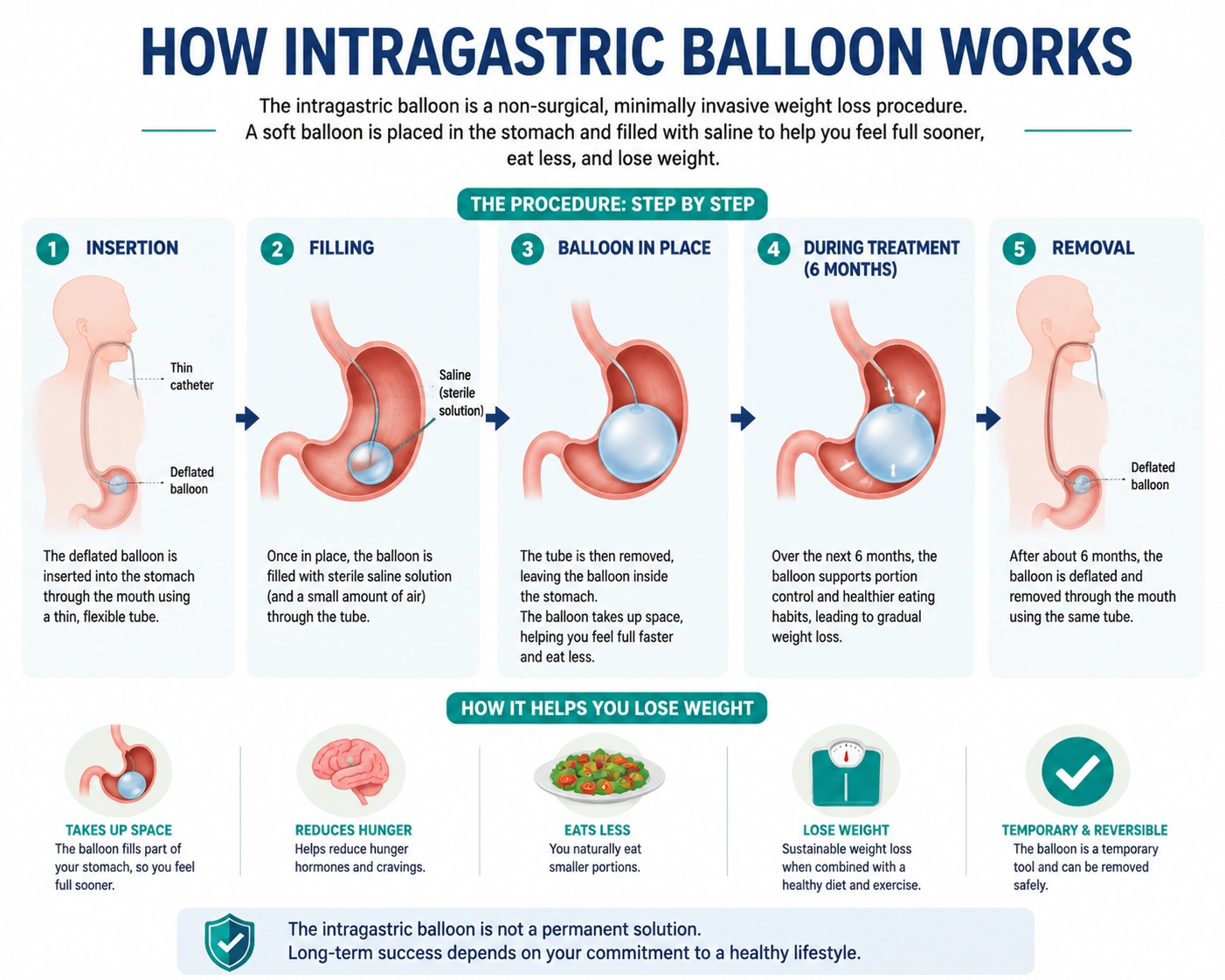 intragastric balloon malaysia