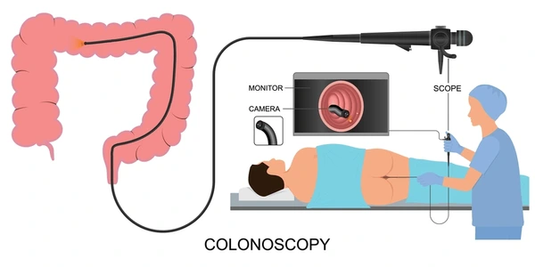 Colonoscopy1