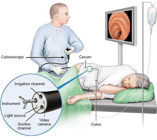 Colonoscopy2