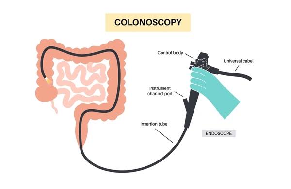 Colonoscopy3