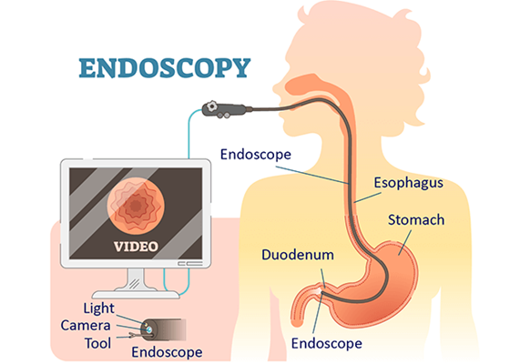 Endoscopy1