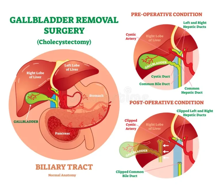 Gallbladder Surgery1