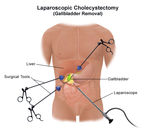 Gallbladder Surgery2