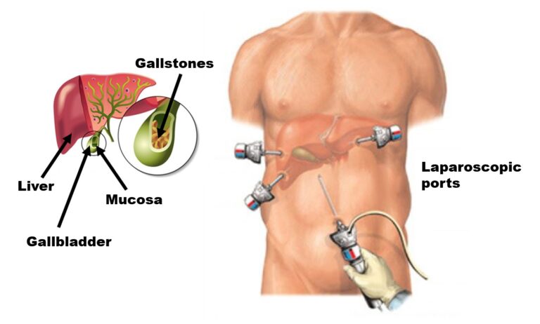 Gallbladder Surgery4