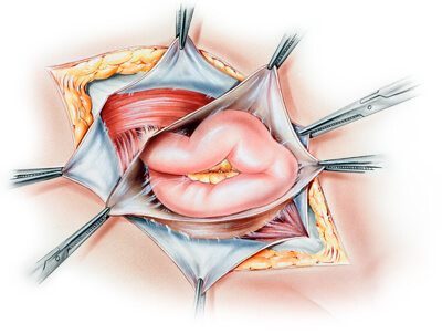 Hernia Surgery1