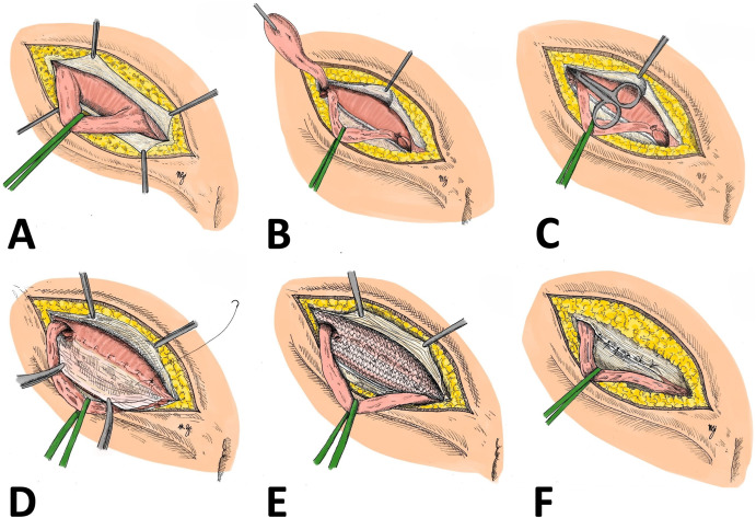 Hernia Surgery4