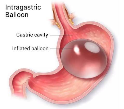 Intragastric Balloon1