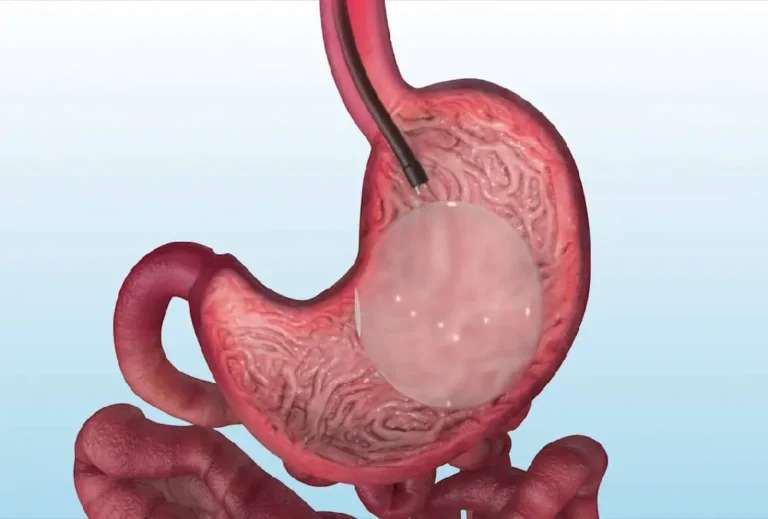 Intragastric Balloon2
