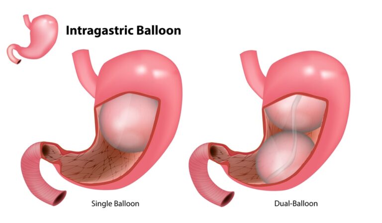 Intragastric Balloon3