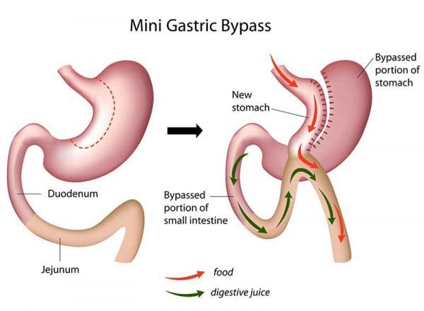 OAGB One Anastomosis Gastric Bypass1