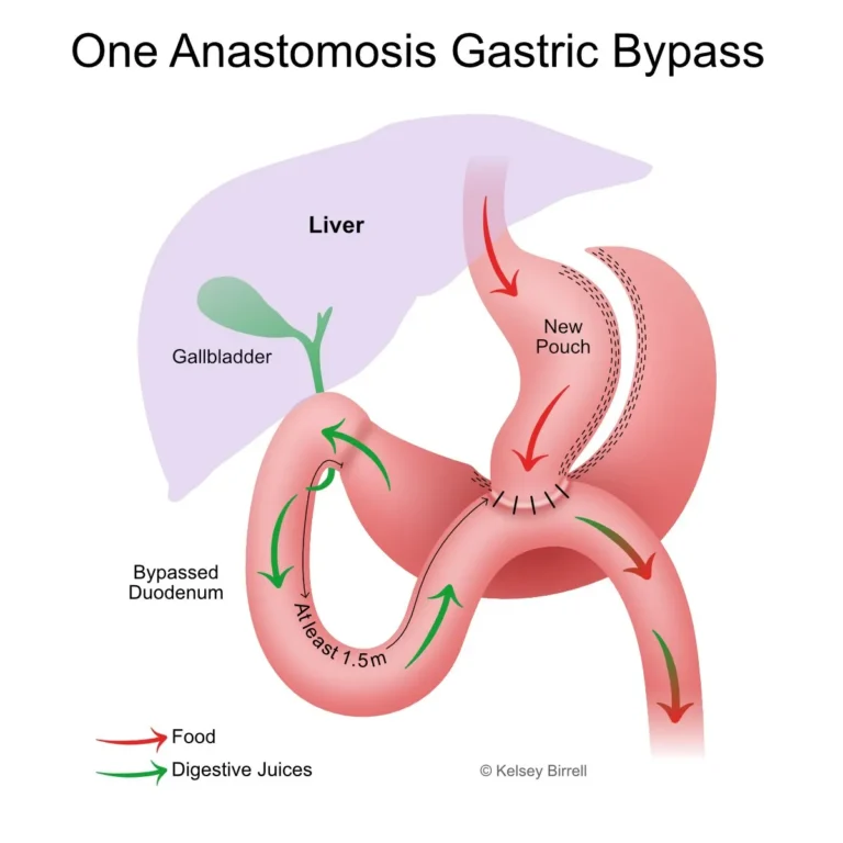 OAGB One Anastomosis Gastric Bypass4