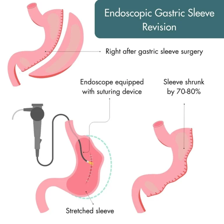 Revisional Bariatric Surgery1