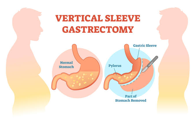 Sleeve Gastrectomy 1