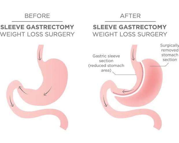 Sleeve Gastrectomy 2