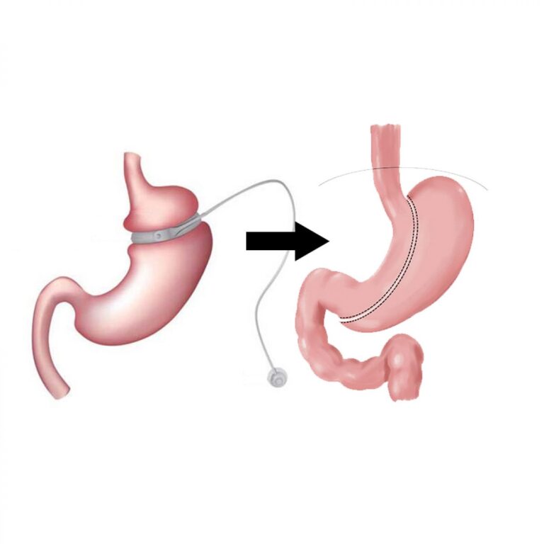 revisional bariatric surgery2