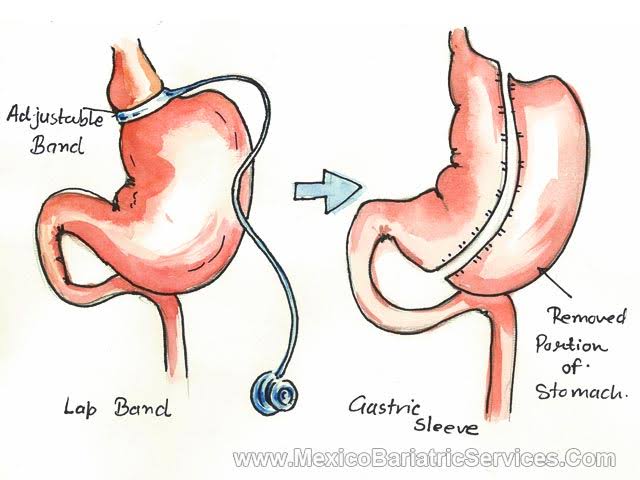 revisional bariatric surgery4